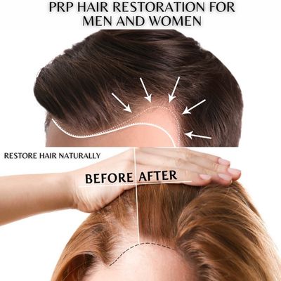 PRP hair restauration